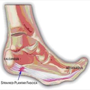 Persistent Sciatic Artery Radiology - Sciatica Pregnancy