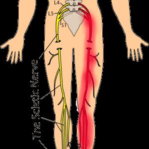 Sciatica Nerves 