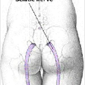 Sciatic Injury Symptoms - Sciatica- Causes And Treatments: Savannah, GA. Jacksonville, FL.