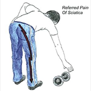 Medical Specialists For Sciatica - Chiropractor, Tampa: Low Back Pain And Sciatica.
