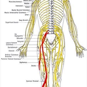 Sciatic Hernia - SCIATICA - AYURVEDA