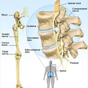 Sciatic Injury Symptoms - Sciatica- Causes And Treatments: Savannah, GA. Jacksonville, FL.