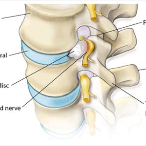 Sciatic Numbness - Back Pain In Pregnant Women--Why Your Low Back Hurts During Pregnancy, And How To Get Relief