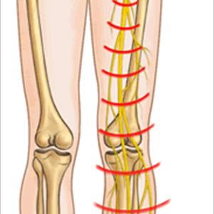 Sciatic Muscle Picture - SCIATICA - TREATING WITHOUT SURGERY (AYURVEDA)