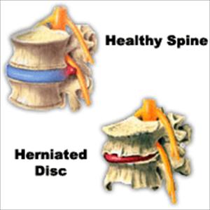 Low Back Pain Sciatica 