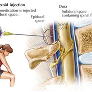 Piriformis Sciatic Pain 