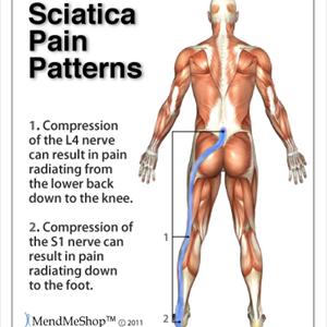 Pinched Sciatic Nerve Spine - Chiropractor, Tampa: Low Back Pain And Sciatica.