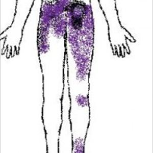 Sciatic Neuralgia - Herbs As A Sciatica Alternative Remedy