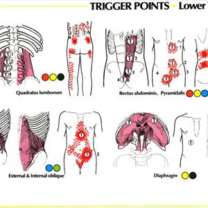  Is Discectomy Spine Surgery Right For My Sciatica?