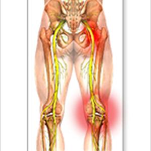 Sciatica Relief Exercises Treatments 