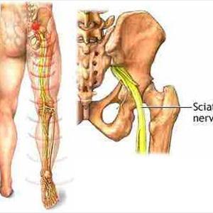 Herbs For Sciatica - Back Problems Leading To Sciatica Pain