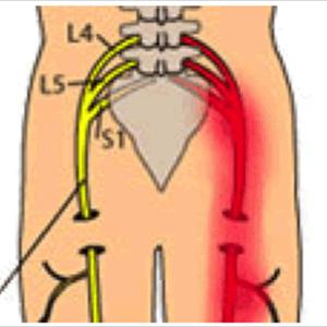 Sciatica Exercises And Stretches - Different Type Of Exercises