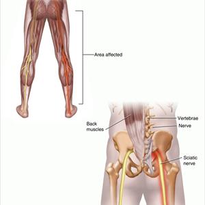 Back Sciatica Diagrams - Sciatica Exercises That Relieve Back Pain