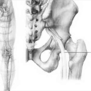 Piriformis Sciatic Nerve Entrapment - Ischias: Sciatic Nerve Or Sciatica